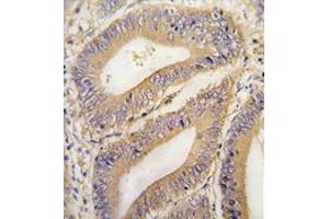 Formalin-fixed and paraffin-embedded human colon carcinoma tissue reacted with PHB2 Antibody (N-term) , which was peroxidase-conjugated to the secondary antibody, followed by DAB staining. (Prohibitin 2 antibody  (N-Term))