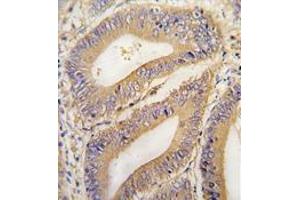 Formalin-fixed and paraffin-embedded human colon carcinoma tissue reacted with PHB2 Antibody (N-term) , which was peroxidase-conjugated to the secondary antibody, followed by DAB staining.