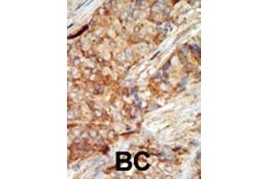 Formalin-fixed and paraffin-embedded human cancer tissue reacted with the primary antibody, which was peroxidase-conjugated to the secondary antibody, followed by AEC staining. (GCK antibody  (N-Term))