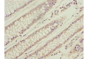 Immunohistochemistry of paraffin-embedded human colon cancer using ABIN7166319 at dilution of 1:100 (WNT9A antibody  (AA 206-365))