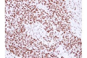 IHC-P Image Immunohistochemical analysis of paraffin-embedded human breast cancer, using SNRPA, antibody at 1:250 dilution. (SNRPA1 antibody  (C-Term))