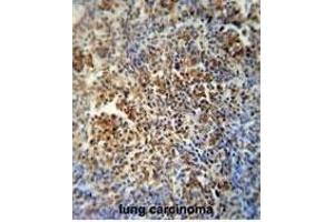 F1 antibody (Center) (ABIN654163 and ABIN2844027) immunohistochemistry analysis in forlin fixed and paraffin embedded hun lung carcino followed by peroxidase conjugation of the secondary antibody and DAB staining. (MAF1 antibody  (AA 90-117))