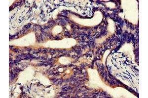 Immunohistochemistry of paraffin-embedded human colon cancer using ABIN7144881 at dilution of 1:100 (ABCA5 antibody  (AA 1230-1355))