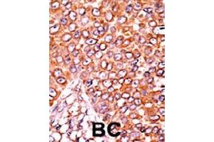Formalin-fixed and paraffin-embedded human cancer tissue reacted with CDKN1B (phospho T157) polyclonal antibody  which was peroxidase-conjugated to the secondary antibody followed by AEC staining.
