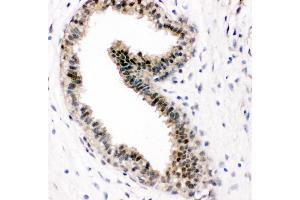 Anti-VCP antibody, IHC(P) IHC(P): Human Mammary Cancer Tissue (VCP antibody  (C-Term))