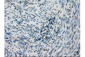 Immunohistochemical staining of paraffin-embedded Carcinoma of thyroid tissue using anti-STK39mouse monoclonal antibody. (STK39 antibody)