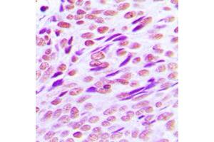 Immunohistochemical analysis of CTBP2 staining in human breast cancer formalin fixed paraffin embedded tissue section. (CTBP2 antibody  (C-Term))