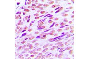 Immunohistochemical analysis of CTBP2 staining in human breast cancer formalin fixed paraffin embedded tissue section.