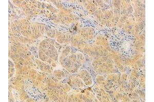 ABIN6261619 and ABIN6276751 at 1/100 staining human lung adenocarcinoma by IHC-P. (ETS1 antibody  (Internal Region))