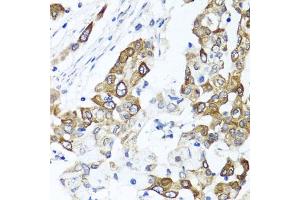 Immunohistochemistry of paraffin-embedded human colon carcinoma using PPOX antibody (ABIN6129092, ABIN6146051, ABIN6146052 and ABIN6222026) at dilution of 1:100 (40x lens). (PPOX antibody  (AA 1-280))