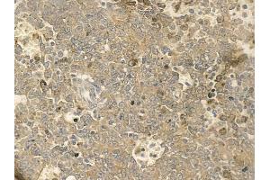 ABIN6259273 and ABIN6273655 at 1/100 staining human melanoma by IHC-P. (FIL1h antibody  (C-Term))