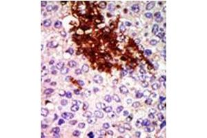 Formalin-fixed and paraffin-embedded human cancer tissue (breast carcinoma) reacted with the primary antibody, which was peroxidase-conjugated to the secondary antibody, followed by DAB staining. (RIOK1 antibody  (N-Term))