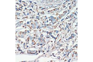 Immunohistochemistry of paraffin-embedded human breast cancer using APC antibody (ABIN1678689, ABIN1678690, ABIN5664154 and ABIN6219837) at dilution of 1:200 (40x lens). (APC antibody  (AA 2544-2843))
