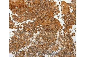 Immunohistochemistry of Human ovarian cancer using TFF2 Polyclonal Antibody at dilution of 1:40 (Trefoil Factor 2 antibody)
