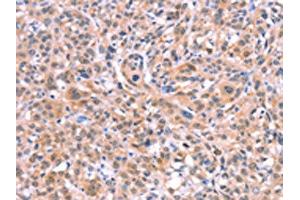 The image on the left is immunohistochemistry of paraffin-embedded Human esophagus cancer tissue using ABIN7128670(BMPR2 Antibody) at dilution 1/35, on the right is treated with fusion protein. (BMPR2 antibody)