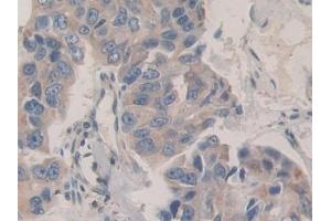 Detection of CDH16 in Human Breast cancer Tissue using Polyclonal Antibody to Cadherin 16 (CDH16) (Cadherin-16 antibody  (AA 37-287))