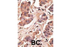 Formalin-fixed and paraffin-embedded human cancer tissue reacted with MAGEH1 polyclonal antibody  , which was peroxidase-conjugated to the secondary antibody, followed by DAB staining. (MAGEH1 antibody  (C-Term))