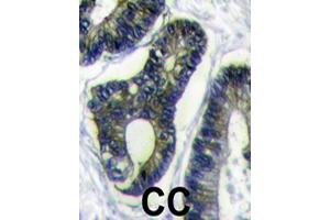 Formalin-fixed and paraffin-embedded human colon carcinoma reacted with FAU polyclonal antibody  , which was peroxidase-conjugated to the secondary antibody, followed by DAB staining. (FAU antibody  (C-Term))