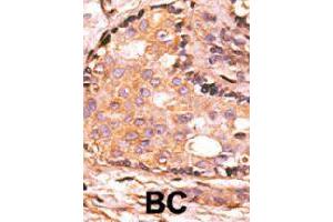 Formalin-fixed and paraffin-embedded human breast cancer tissue reacted with DUSP4 polyclonal antibody  , which was peroxidase-conjugated to the secondary antibody, followed by AEC staining. (DUSP4 antibody  (C-Term))