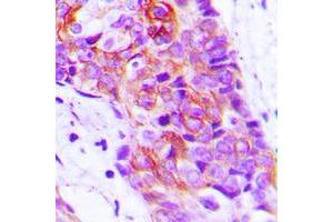 Immunohistochemical analysis of Adenylate Cyclase 9 staining in human breast cancer formalin fixed paraffin embedded tissue section. (ADCY9 antibody  (N-Term))