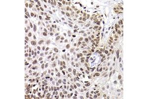 Immunohistochemistry of paraffin-embedded human well-differentiated squamous skin carcinoma using PHIP antibody (ABIN5974339) at dilution of 1/100 (40x lens). (PHIP antibody)