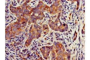 Immunohistochemistry of paraffin-embedded human pancreatic cancer using ABIN7171684 at dilution of 1:100 (TECPR2 antibody  (AA 516-783))