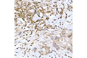 Immunohistochemistry of paraffin-embedded human breast cancer using TFEB Rabbit pAb (ABIN6128819, ABIN6149043, ABIN6149045 and ABIN6223149) at dilution of 1:100 (40x lens). (TFEB antibody)