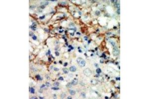 Formalin-fixed and paraffin-embedded human cancer tissue reacted with the primary antibody, which was peroxidase-conjugated to the secondary antibody, followed by AEC staining. (EPH Receptor A3 antibody  (N-Term))