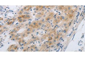 Immunohistochemistry of paraffin-embedded Human liver cancer using GJB6 Polyclonal Antibody at dilution of 1:30 (GJB6 antibody)