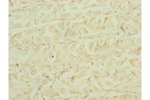 Immunohistochemistry of paraffin-embedded human gastric cancer using ABIN7151546 at dilution of 1:100 (EEF1G antibody  (AA 168-437))