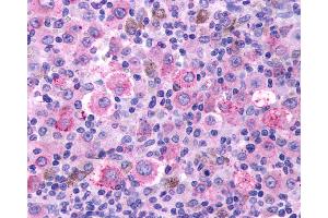 Anti-TBXA2R / Thromboxane Receptor antibody IHC of human Skin, Melanoma. (TBXA2R antibody  (C-Term))