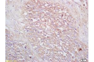 Formalin-fixed and paraffin embedded human lung carcinoma labeled with Rabbit Anti VIP receptor 2/VPAC2 Polyclonal Antibody, Unconjugated (ABIN726170) at 1:200 followed by conjugation to the secondary antibody and DAB staining