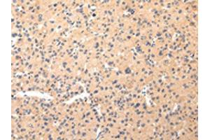 The image on the left is immunohistochemistry of paraffin-embedded Human liver cancer tissue using ABIN7190330(COL8A2 Antibody) at dilution 1/20, on the right is treated with synthetic peptide. (COL8a2 antibody)