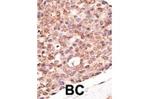Formalin-fixed and paraffin-embedded human breast cancer tissue reacted with CRY2 polyclonal antibody  , which was peroxidase-conjugated to the secondary antibody, followed by DAB staining. (CRY2 antibody  (C-Term))