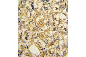 Formalin-fixed and paraffin-embedded human breast carcinoma reacted with PDGFRB Antibody (N-term), which was peroxidase-conjugated to the secondary antibody, followed by DAB staining. (PDGFRB antibody  (N-Term))