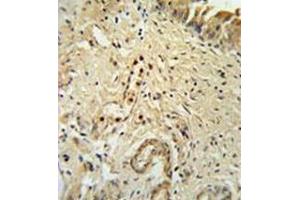 Immunohistochemistry analysis in formalin fixed and paraffin embedded bladder carcinoma reated with ID4 Antibody (N-term) followed which was peroxidase conjugated to the secondary antibody and followed by DAB staining. (ID4 antibody  (N-Term))