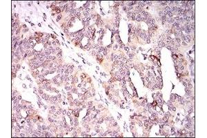 Immunohistochemical analysis of paraffin-embedded human ovarian cancer tissues using KIF11 mouse mAb with DAB staining. (KIF11 antibody)
