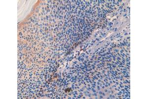 IHC-P analysis of skin cancer tissue, with DAB staining. (SLIT3 antibody  (AA 1405-1512))