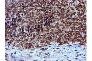 Immunohistochemical staining of paraffin-embedded Adenocarcinoma of Human breast tissue using anti-RFXANK mouse monoclonal antibody. (RFXANK antibody)