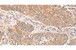 Immunohistochemistry of paraffin-embedded Human lung cancer using RPS6KA1 Polyclonal Antibody at dilution of 1:30 (RPS6KA1 antibody)