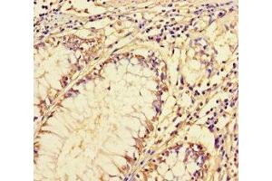 Immunohistochemistry of paraffin-embedded human colon cancer using ABIN7143489 at dilution of 1:100 (ARL16 antibody  (AA 1-197))