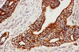 Anti-Secretogranin 3 antibody, IHC(P) IHC(P): Human Rectal Cancer Tissue (SCG3 antibody  (C-Term))