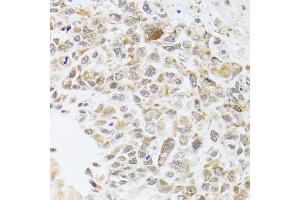 Immunohistochemistry of paraffin-embedded human lung cancer using RNASEL antibody. (RNASEL antibody)