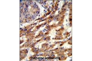 Formalin-fixed and paraffin-embedded human hepatocarcinoma reacted with ERGIC3 Antibody (N-term), which was peroxidase-conjugated to the secondary antibody, followed by DAB staining. (ERGIC3 antibody  (N-Term))