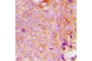 Immunohistochemical analysis of MRPS9 staining in human breast cancer formalin fixed paraffin embedded tissue section. (MRPS9 antibody)