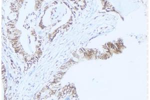 ABIN6275467 at 1/100 staining Human lung cancer tissue by IHC-P. (RAB37 antibody  (C-Term))
