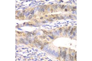 Immunohistochemistry of paraffin-embedded human colon carcinoma using UBE2C antibody. (UBE2C antibody  (AA 1-179))