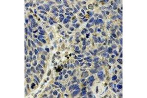 Immunohistochemical analysis of SCOT staining in human esophageal cancer formalin fixed paraffin embedded tissue section. (OXCT1 antibody)