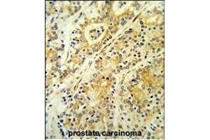 Formalin-fixed and paraffin-embedded human prostate carcinoma reacted with MGST2 Antibody (C-term),which was peroxidase-conjugated to the secondary antibody, followed by DAB staining. (MGST2 antibody  (C-Term))