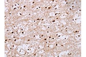 The image on the left is immunohistochemistry of paraffin-embedded Human brain tissue using ABIN7130476(NUP50 Antibody) at dilution 1/30, on the right is treated with fusion protein. (NUP5 antibody)